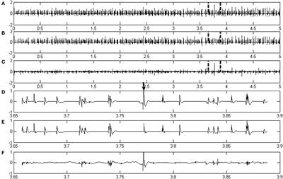 Intramuscular EMG Decomposition Basing on Motor Unit Action Potentials Detection and Superposition Resolution